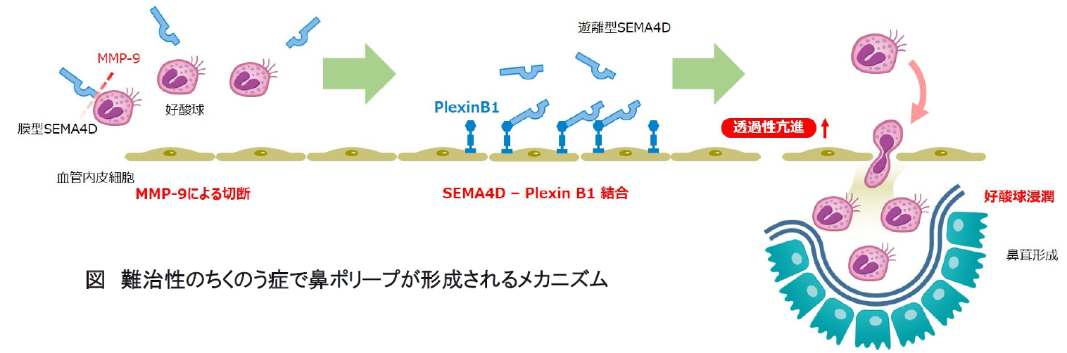 難治性の蓄膿症で鼻ポリープが形成されるメカニズム